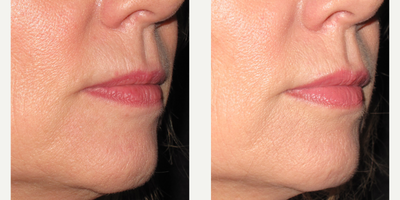 Volbella before and after photo