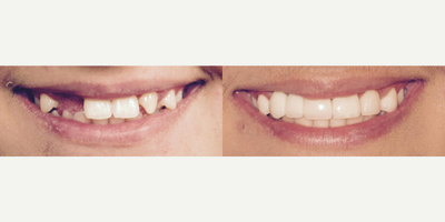 Dental Bridge before and after photo