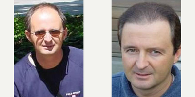 FUE Hair Transplant before and after photo
