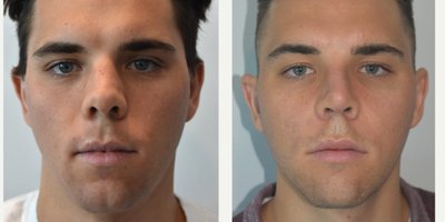 Rhinoplasty before and after photo