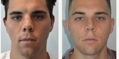 Rhinoplasty before and after photo