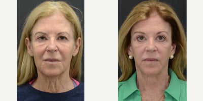 SMAS Facelift before and after photo