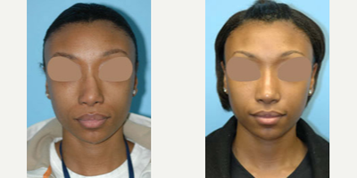 African American Rhinoplasty before and after photo