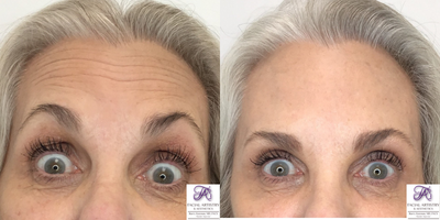 Botox before and after photo