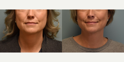 Chin Liposuction before and after photo
