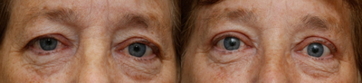 Eyelid Surgery before and after photo