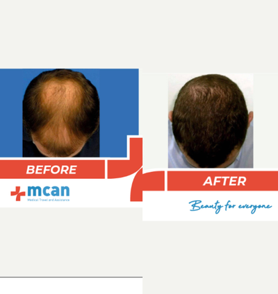 FUE Hair Transplant before and after photo