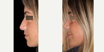 Rhinoplasty before and after photo