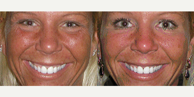 Botox before and after photo