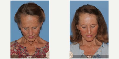 Botox before and after photo