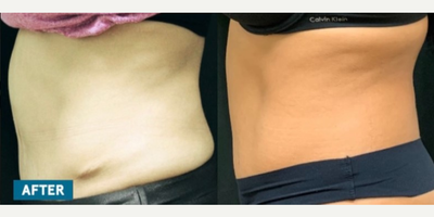 Emsculpt before and after photo