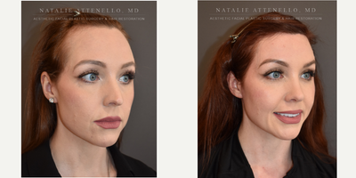 Forehead Reduction before and after photo