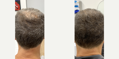 Microneedling before and after photo