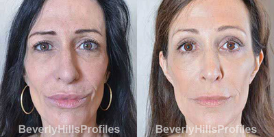 Rhinoplasty before and after photo