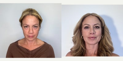 Eyelid Surgery before and after photo