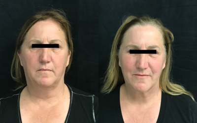 Facial Fat Transfer before and after photo