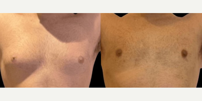 Gynecomastia Surgery before and after photo