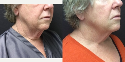 Infini RF before and after photo