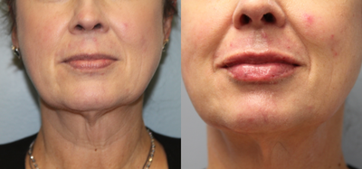Juvederm before and after photo
