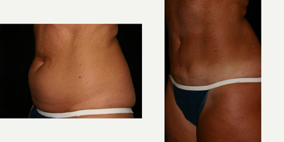 Liposculpture before and after photo