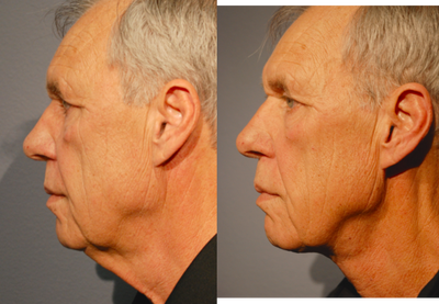Neck Lift before and after photo