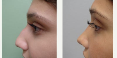 Rhinoplasty before and after photo