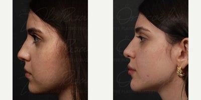 Buccal Fat Removal before and after photo