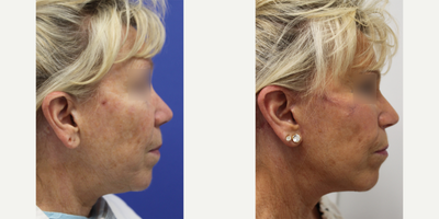 Facelift before and after photo