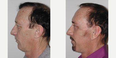 Facelift before and after photo