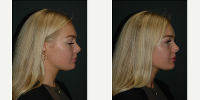 Lip Fillers before and after photo