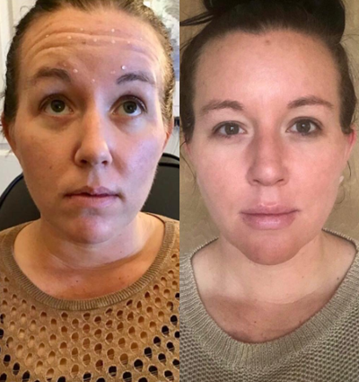 Liquid Facelift before and after photo