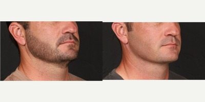 Neck Lift before and after photo