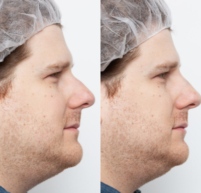 Nonsurgical Nose Job before and after photo