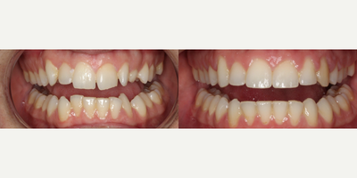 Clear Braces before and after photo