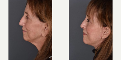 Laser Resurfacing before and after photo