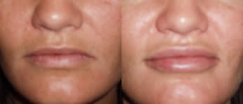 Lip Fillers before and after photo