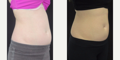 CoolSculpting before and after photo