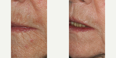 Fractional Laser before and after photo