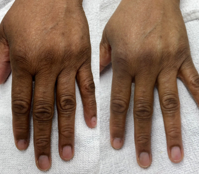 Hand Rejuvenation before and after photo