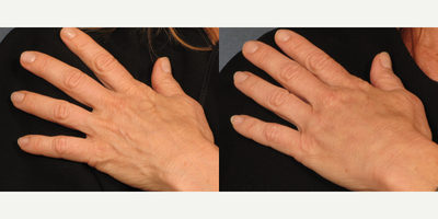 Radiesse before and after photo