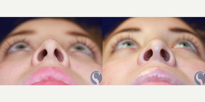 Rhinoplasty before and after photo