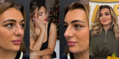 Rhinoplasty before and after photo