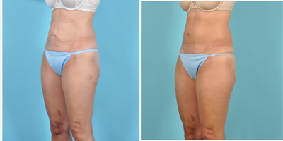 Tummy Tuck before and after photo