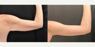 Arm Lift before and after photo