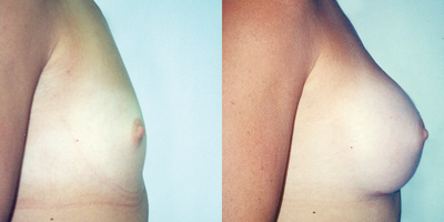 Breast Augmentation before and after photo