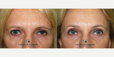 Brow Lift before and after photo