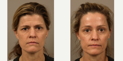 Brow Lift before and after photo