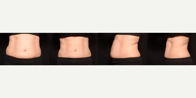 CoolSculpting before and after photo