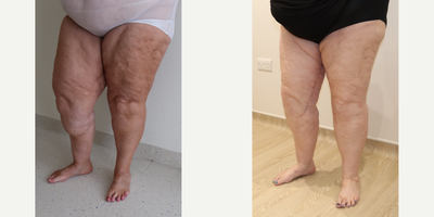 Lipedema Surgery before and after photo