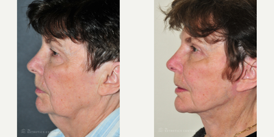 Neck Lift before and after photo